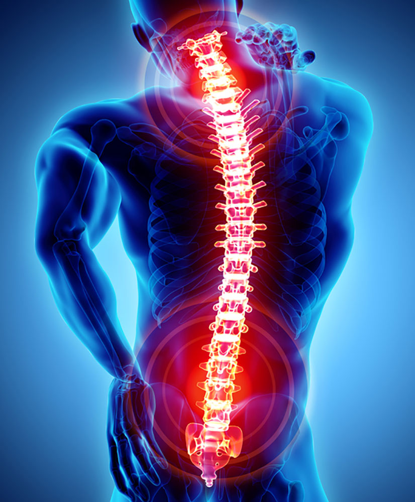 Pain Relief via a Spinal Cord Stimulator